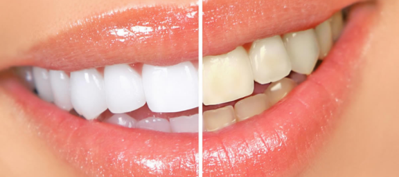 clareamento dental